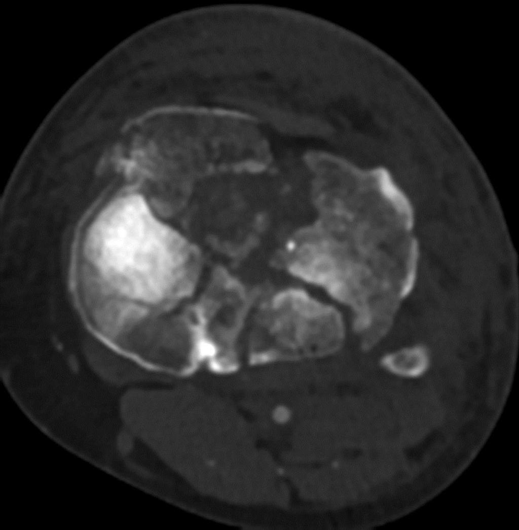 48 YOM MCC Bicondylar tibial plateau fractures: Schatzker 5 or 6 AO C-type fxs Posteromedial fx