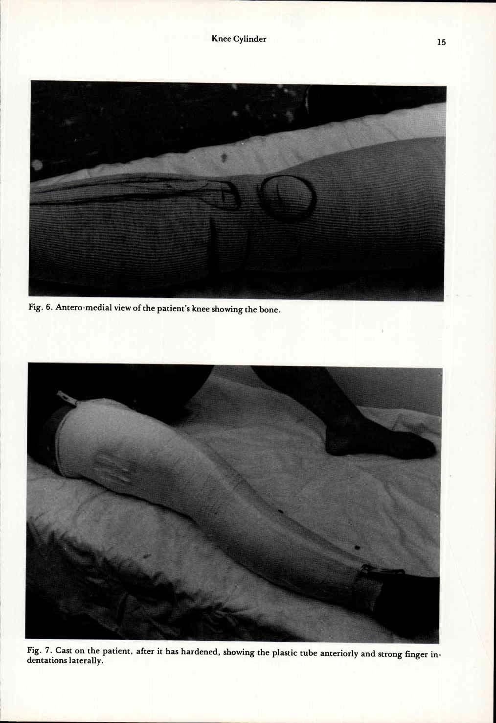 Fig. 6. Antero-medial view of the patient's knee showing the bone. Fig. 7.