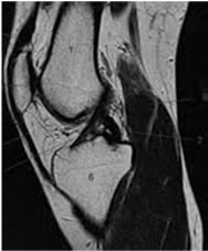 Functional tests should be about 85% 90% of normal side I/N =% Determination of healing and maturation of graft by MRI (Univ. of Pitt.