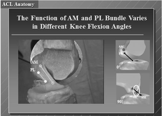 (tightest in flexion) Posterior lateral bundle" attaches on
