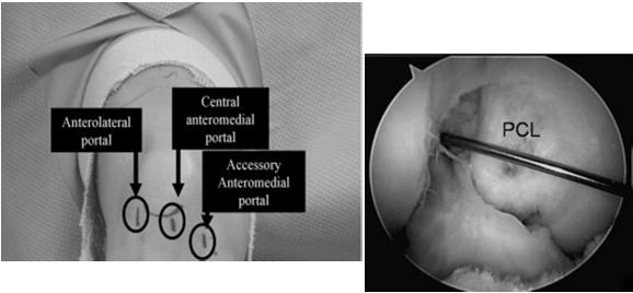 Anatomic ACL Reconstruction PL bundle Accessory Medial