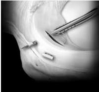suturing device bone