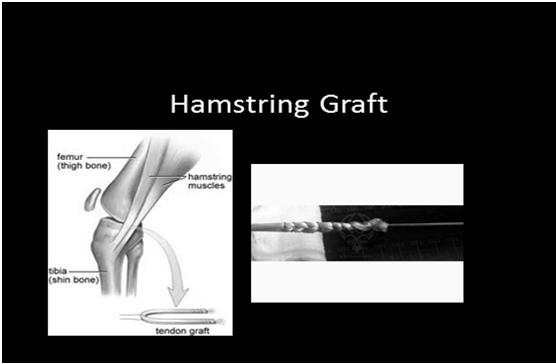 Must be >8mm in diameter Closed end stripper Open ended stripper Hamstring