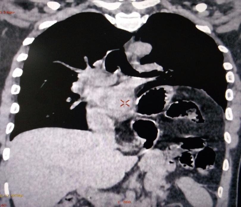 CT scan of chest (coronal section); showed herniation of stomach & splenic flexure of colon, along with collapse of lung and mediastinal shifting to the opposite side, can be seen.