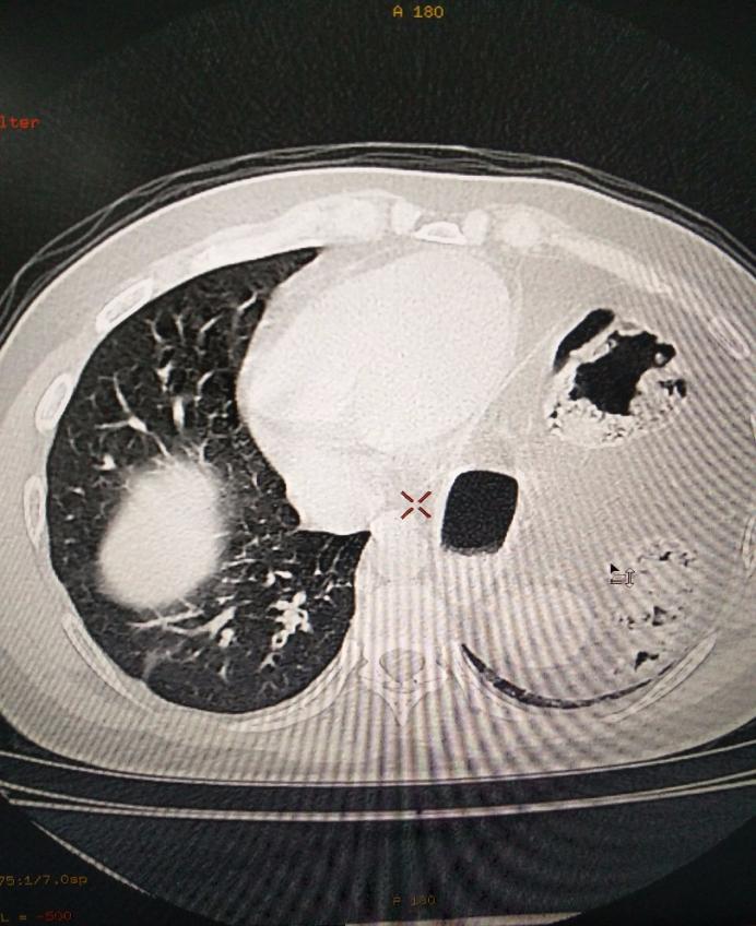 64% of predicted, total lung capacity 58% of predicted, suggestive of restrictive pattern. Emergency surgery was decided upon following consultation with the thoracic surgery department.