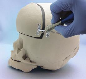 DISTRACTOR REMOVAL Remove the distractor after consolidation period has been achieved. Step 1 Make the cranial incision and expose the distractor.