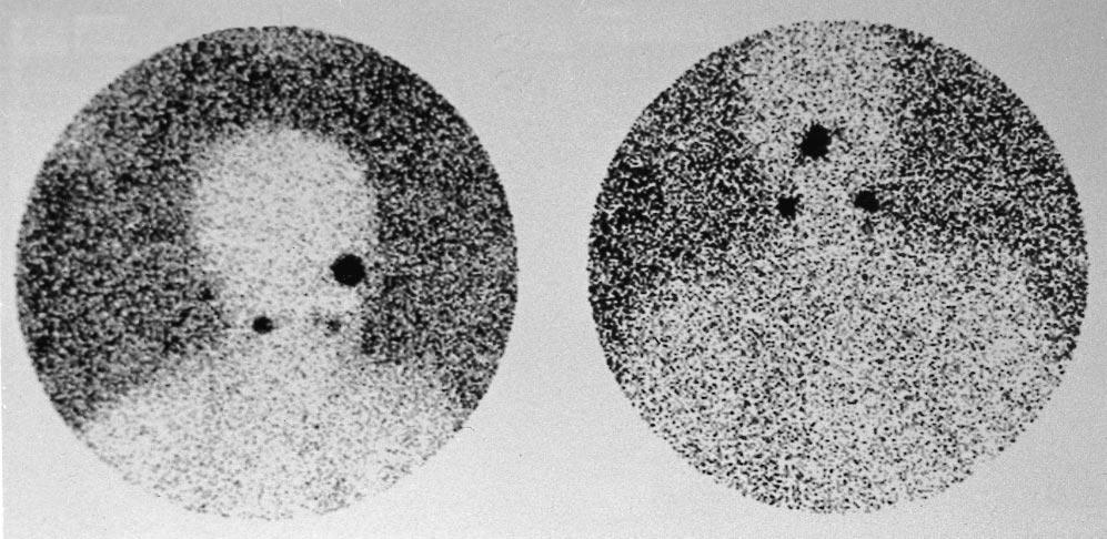 Rt (15 min) Ant (20 min) Rt Lt Lymphoscintigraphy of a patient with a 2.3-mm-thick melanoma of the nasal tip is shown. Note the lymphatic drainage to nodes around the facial vessels bilaterally.
