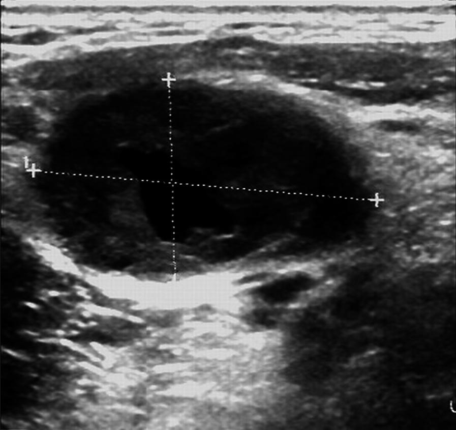Ultrasonographic features in differential diagnosis of cervical lymph nodes metastasis ultrasound parameters ranged from 0.375-0.961, and p=0.000 for all parameters (Table 2).