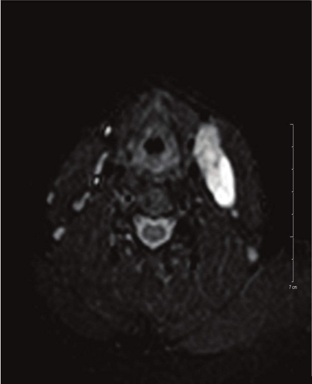 2 Case Reports in Otolaryngology after histopathological examination it was diagnosed to be a cystic enlarged lymph node which was also invaded with thyroid papillary carcinoma, with the review of