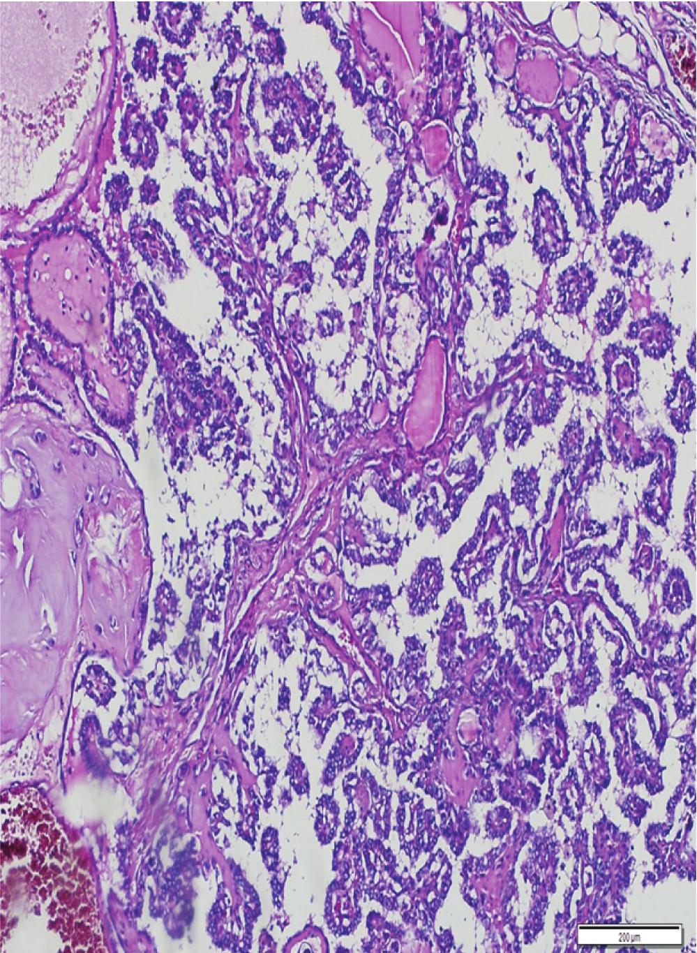 needle aspiration biopsy, T: thyroid, RIA: radioactive iodine ablation, NP: not performed, and PTC: papillary thyroid carcinoma. Figure : Metastatic focus of papillary carcinoma.