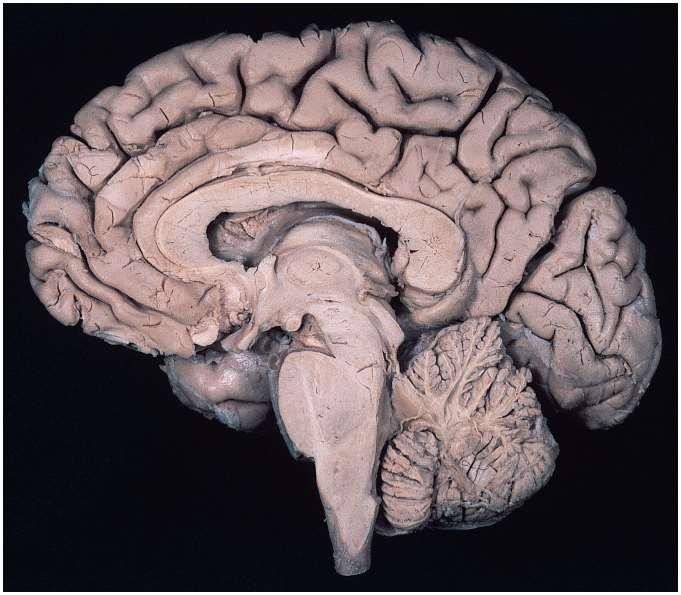 Median Section of Cadaver Brain Cingulate gyrus Corpus callosum Lateral ventricle Choroid plexus Thalamus Hypothalamus Midbrain