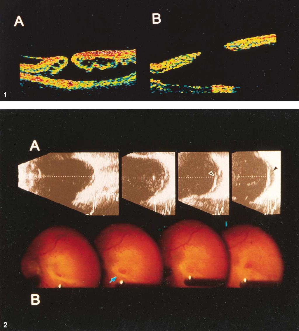 Ophthalmology Volume 108, Number 12, December 2001 Figure 1. Optical coherence tomography (OCT) scans of highly myopic eyes with retinal detachment caused by macular hole (MH).
