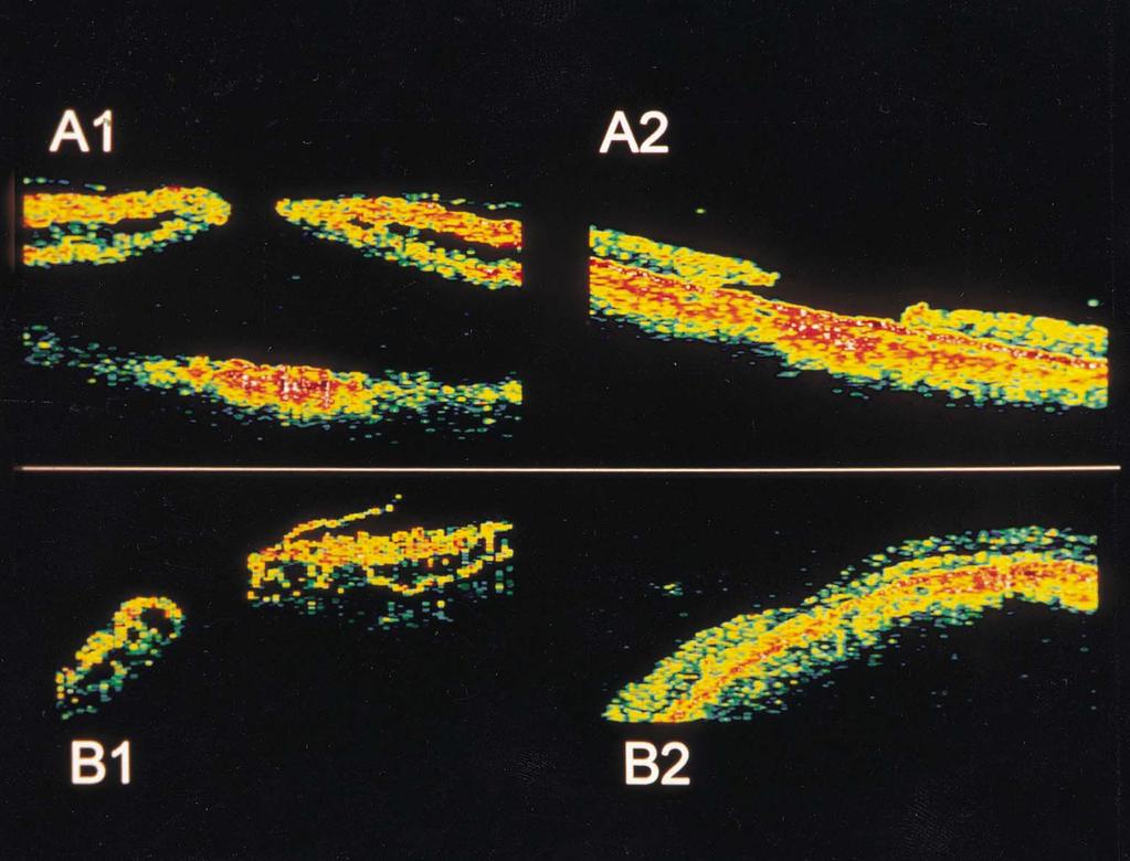 In the remaining 4 successful cases, OCT showed intraretinal spaces of minimal or no reflectivity consistent with the persistence of a certain amount of intraretinal edema.