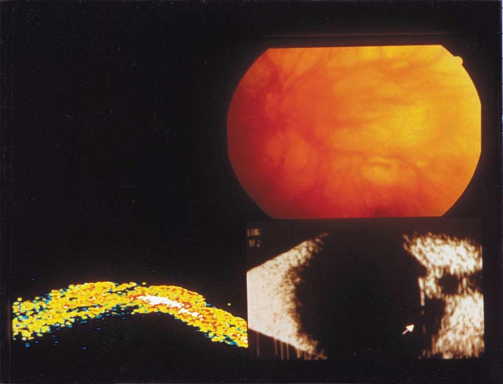 Ripandelli et al Surgical Procedures for Retinal Detachment with Macular Hole in Highly Myopic Eyes Figure 6.