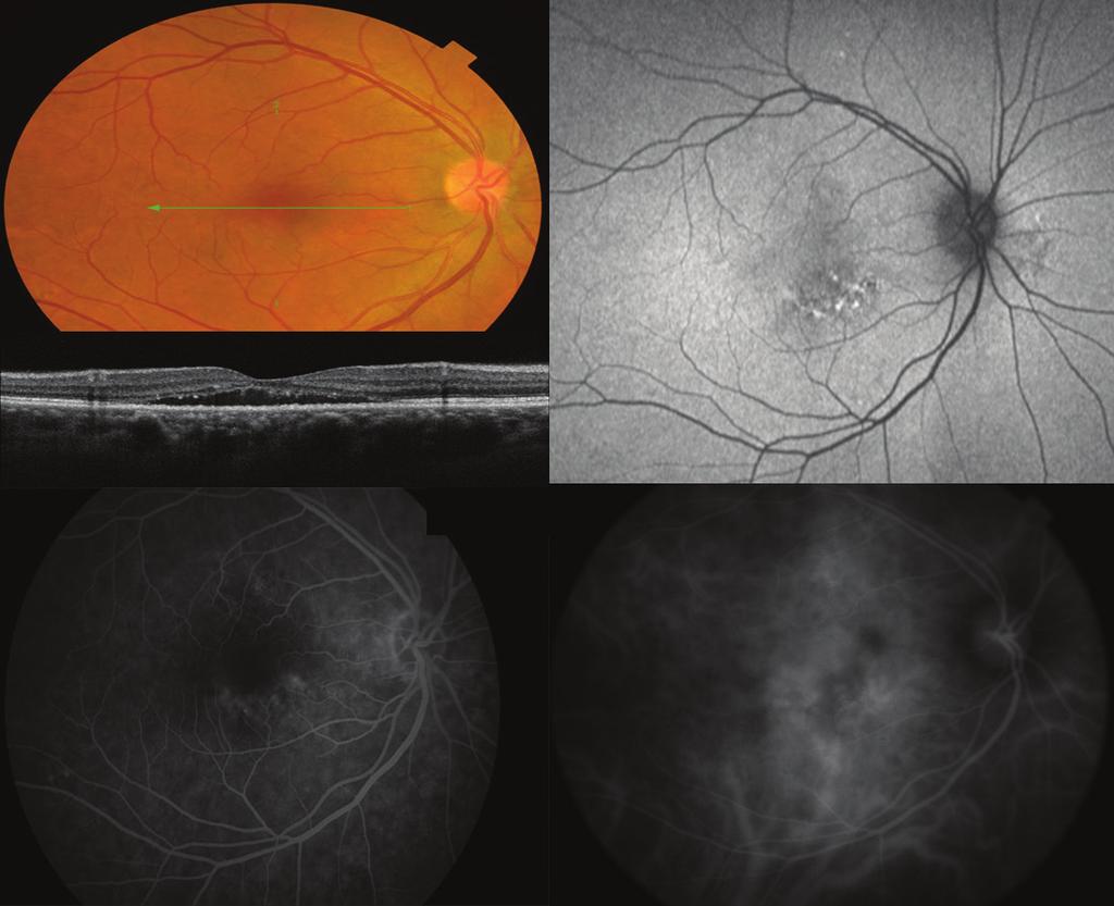 Imaging for diagnosis 4.1 Fundus photography A discrete, clear and serous elevated lesion is observed at the posterior pole (Fig 1).