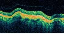 no traction configuration since no distortion is visible on the retinal surface and the angle of insertion of the hyaloid onto the retina is not steep.