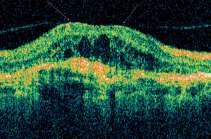 The persistence of hyaloid adhesion causes VMT over the CNV complex: a focal distortion of the retinal profile is visible at the site of hyaloid