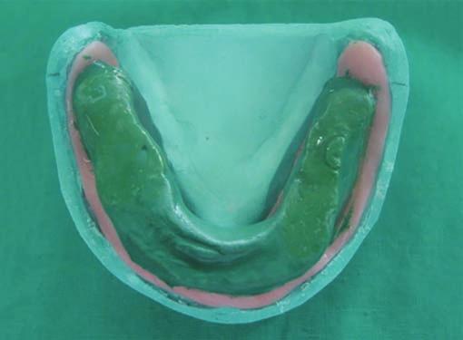 JOHCD Prosthodontic Management of Completely Edentulous Patient with Unilateral Facial Paralysis Fig.