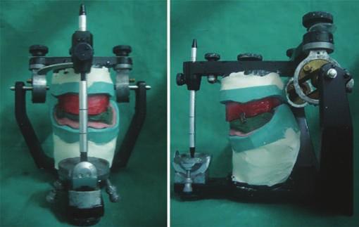transfer done on a semi-adjustable articulator (Hanau Wide Vue) (Figs 5 and 6).