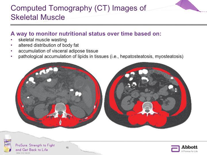 CT imaging can distinguish between different adipose deposits (visceral, subcutaneous, and intermuscular).
