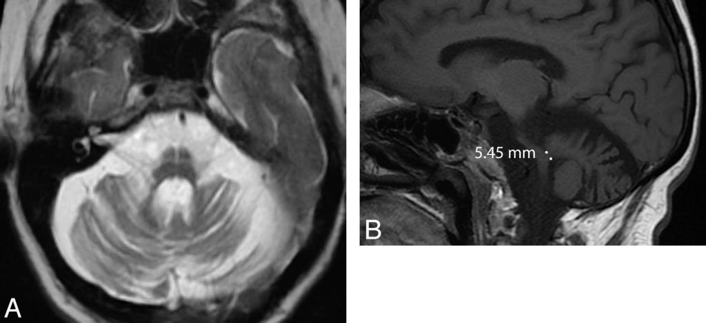 FIG 3. Axial 123 I-FP-CIT DaT-SPECT image in a patient with MSA. Note that imaging appearances are similar to those in idiopathic Parkinson disease, with asymmetric reduction in putaminal uptake.