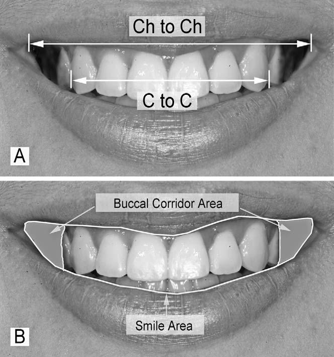 QUANTIFICATION OF THE BUCCAL CORRIDOR SPACE Figure 5. Vribles of posed smile photogrphs.