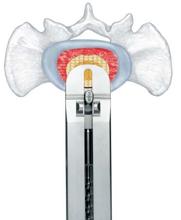 Luminary ALIF Anterior Approach The Luminary ALIF instruments can be used in an anterior lumbar interbody fusion procedure using a