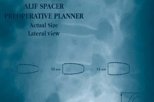 radiograph. 100 % actual size NOTE: All ALIF Spacers are 24 mm in anterior-posterior direction and 30 mm in lateral width.