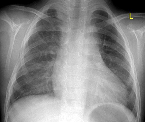 THORACOTOMY Non-cardiac operation (pulmonary/oesophageal)