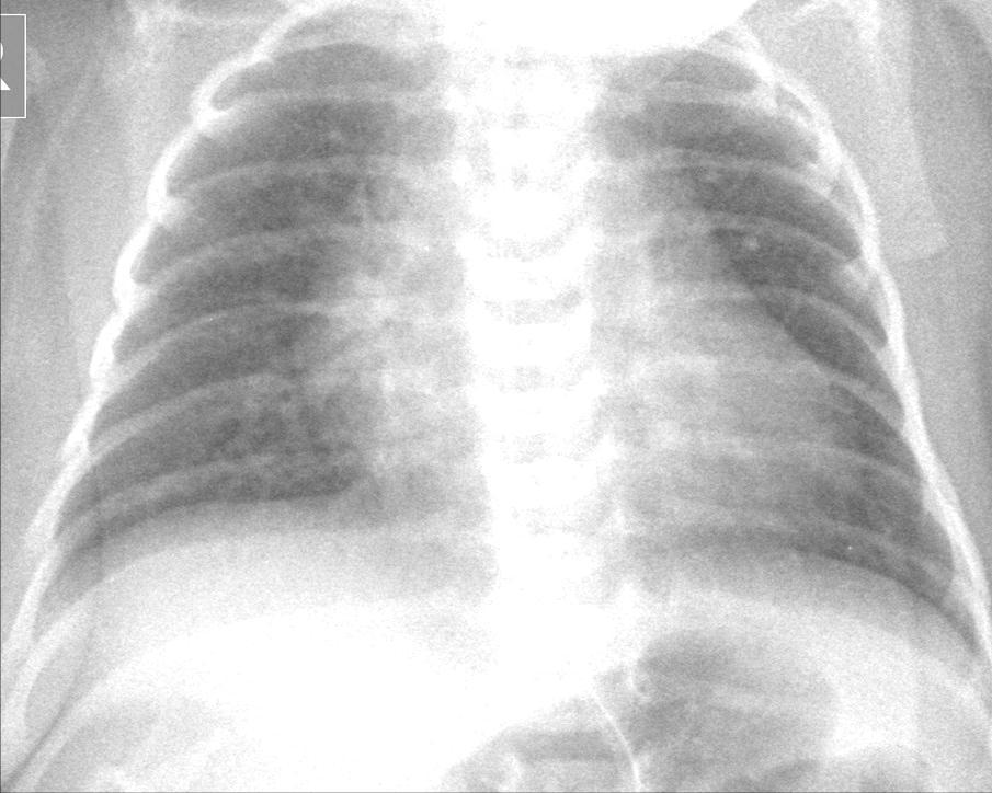 PULMONARY PLETHORA MEANS : increased flow through the lungs CAUSING : enlargement of pulmonary