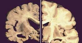 ALZHEIMER S DISEASE Degenerative disorder of the brain Progressive loss of brain cells associated with abnormal