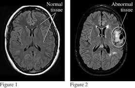 Brain Tumor Detection and Segmentation In MRI Images AbhijithSivarajan S 1, Kamalakar V. Thakare 2, Shailesh Kathole 3, Pramod B. Khamkar 4, Danny J.