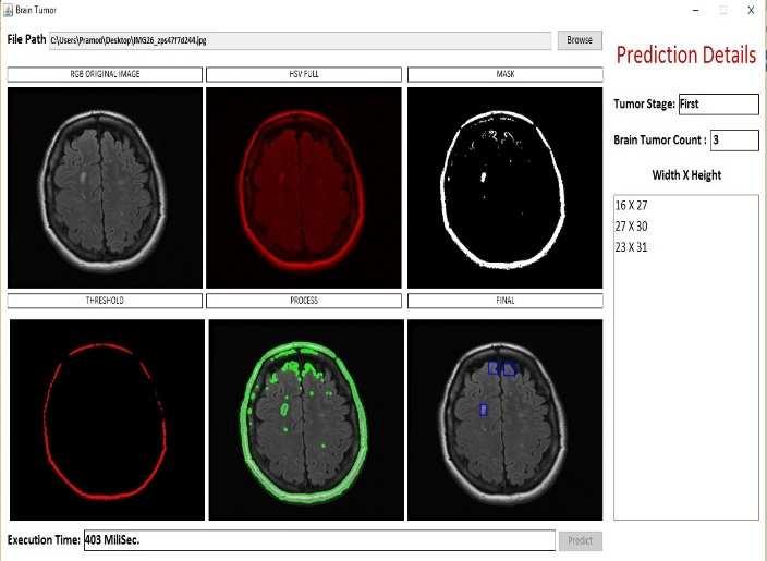 The proposed project will detect the presence of brain tumor with increased accuracy and within a minimum time span, thus developing an efficient and faster tumor detection system. Fig.