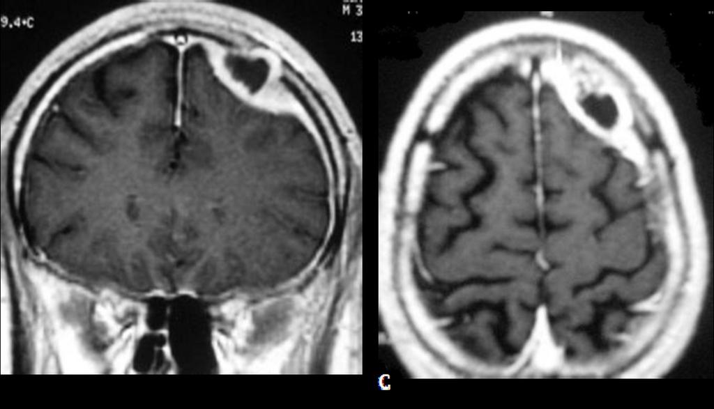 Fig. 10: dural thickning and