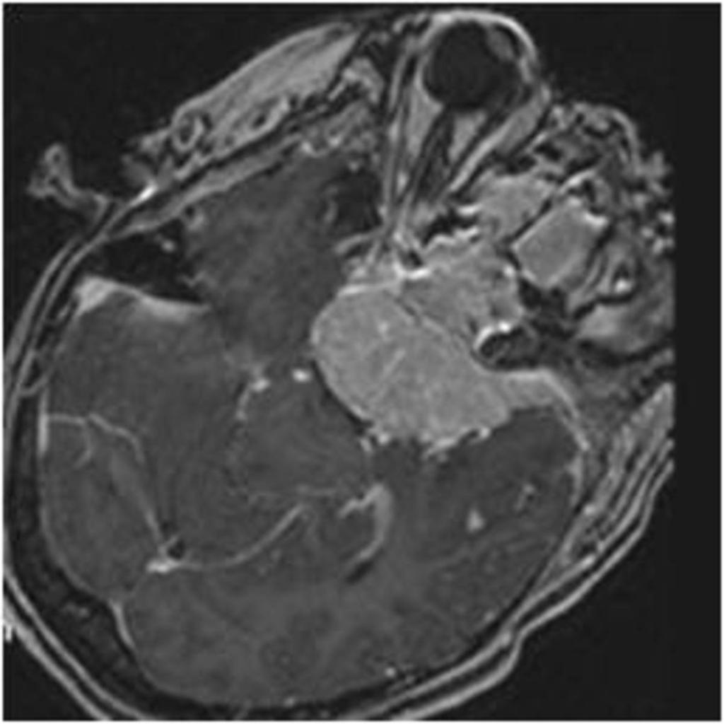 Fig. 12: vertebral and epidural gastric carcinoma metastasis with meningeal
