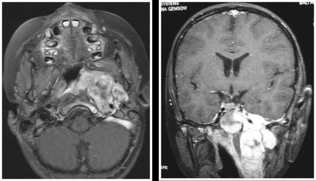 Fig. 14: infra temporal fossa Rhabdomyosarcoma xith intrcranial