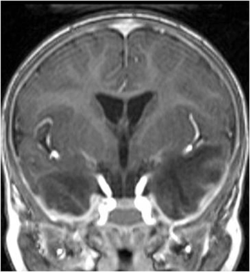 Fig. 15: Both types of meningeal
