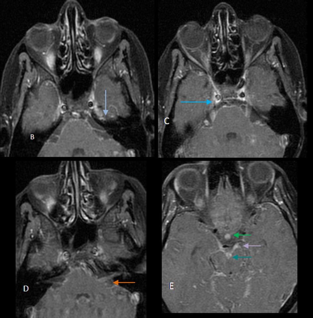 Fig. 3: enhancement on left cranial nerve(ii,iii, V,VI,VII,VIII.