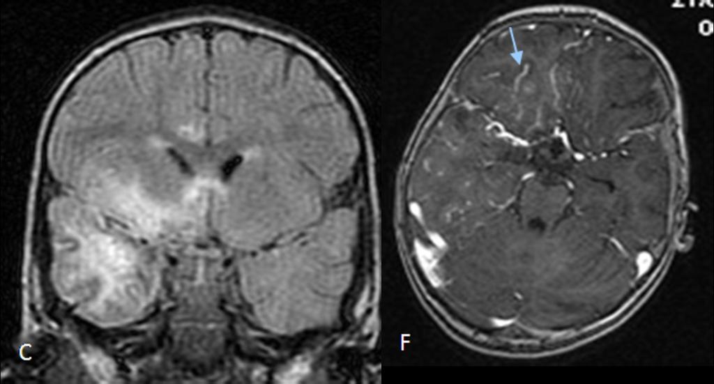 Fig. 5: coronal flair showws marked hyperintensity involving the cortical and the subcortical areas of the anterior and