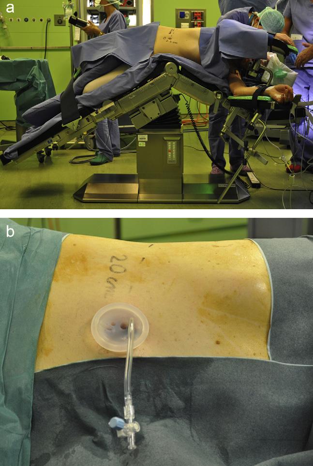 Once the posterior plate of the anastomosis was completed, a DJ stent was inserted retrogradely using a flexible cystoscope in order not to modify the patient s position and the undockingredocking of