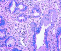 Bhargava et al / MAMMAGLOBIN IN BREAST CARCINOMA Table 6 Mammaglobin Staining in Nonbreast Tumors Tumor Type Mammaglobin Staining * Staining Pattern Melanoma 5/80 (6) Patchy (2 cases) or diffuse (3