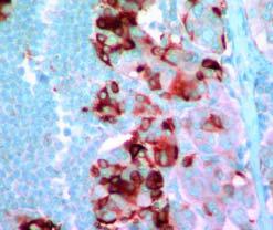 The primary lobular carcinoma showed focal, weak staining, whereas the metastatic tumor showed diffuse, strong positivity.