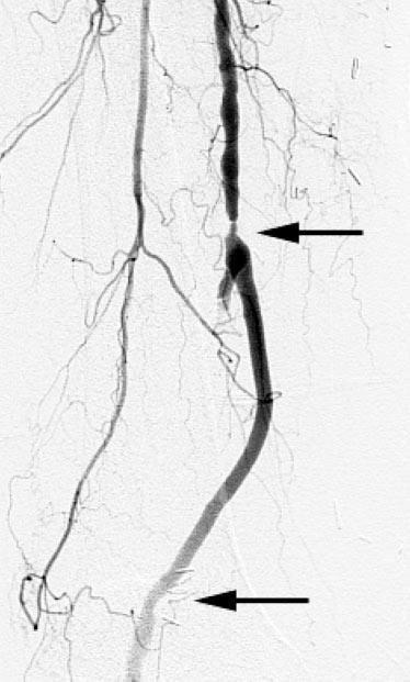 398 OVER-THE-WIRE INVERSION SAPHENECTOMY J ENDOVASC THER to a primary patency of 38% (3/8) for veins 4 mm (n8, p0.001). The limb salvage rate was 92% (22/24).