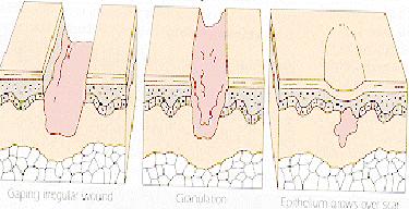 Healing by secondary intention During healing, wounds fill with granulation tissue, a scar forms, and reepithelialization occurs, primarily from the wound edges.