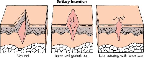 Types of wound healing Tertiary intention: Considered appropriate to delay the closure of a wound Might be to permit further observation or manipulation of the underlying structures or to permit the