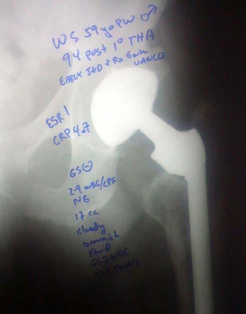 Revision Hip Replacement USA 50,000