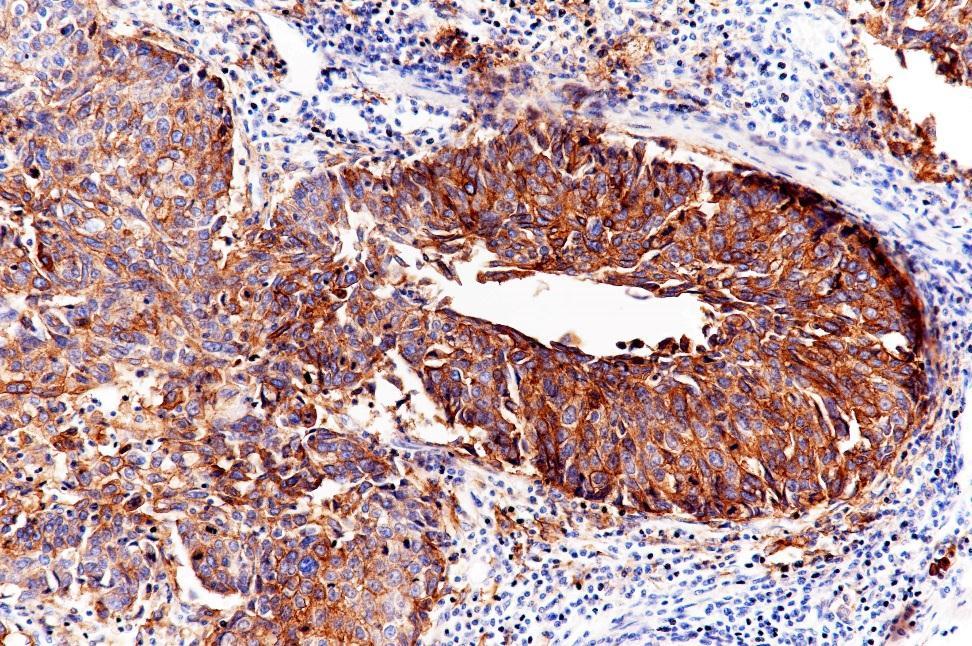 PD-L1 Expression in Lung Squamous Cell Carcinoma Rabbit
