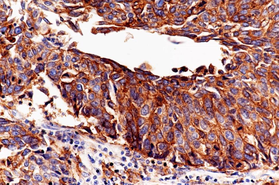 (400X) Result: Positive staining, 3+ Tumor and/or