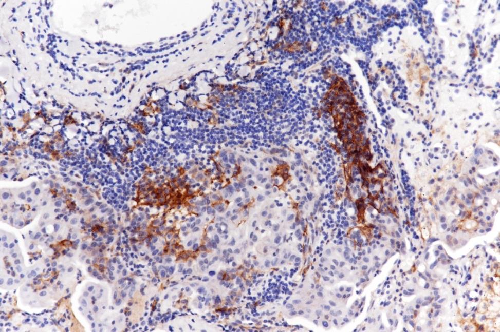 PD-L1 Expression in Lung adenocarcinoma Rabbit Anti-PD-L1/CD274