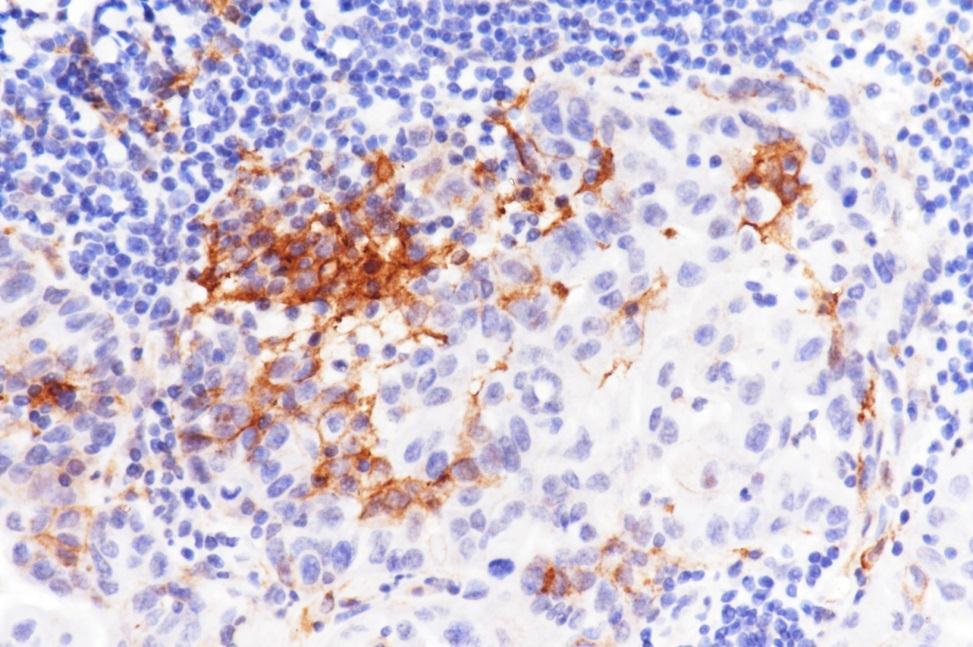 staining, 2+ Tumor and/or infiltrating immune cells 0 ( 1%), 1
